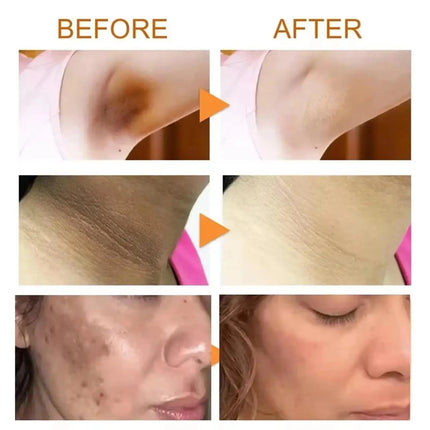 Nicotinamide Brightening Cream For Dark Skin Effective Lighten Thigh Inner Bleach Remove Melanin Private Parts Brighten Cream