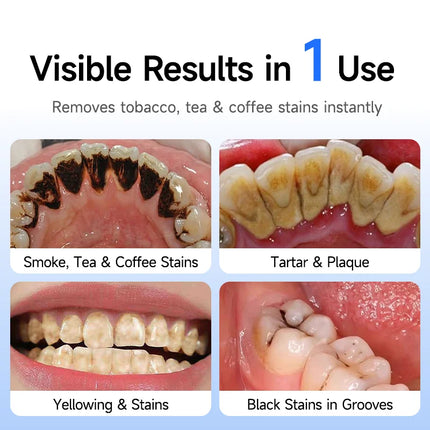 Electric Tooth Polisher Low Noise Dental Scaler Plaque Tartar Remover Tooth Cleaner Deep Cleaning Polishing Teeth Whitening Kit