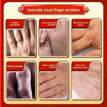 Hand cream for removing wrinkles on finger joints, removing hand wrinkles, and reducing joint roughness and blackness