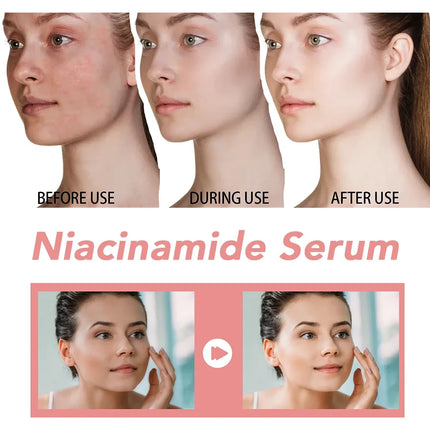 30ml Niacinamide Melanin Fading Melasma Black Spot Corrector Shrinking Pores Hyaluronic Acid Moisturizing Skincare
