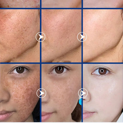 2025 Bestselling Facial Spot-Fading Cream, Effectively Removes Facial Dark Spots