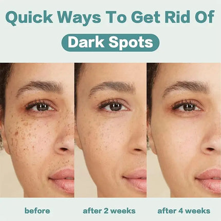Powerful Spot-removing Whiten Cream Brighten Skin Fast Eliminates Melanin Pigmentation Melasma Dark Spots Moisturize Beauty Gel