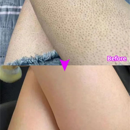 Body Whitening Cream Keratosis Pilaris Treatment Bumpy Rough Chicken Follicle Skin Repair Strawberry Legs Removal Dry Skin Care