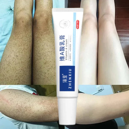 Body Whitening Cream Keratosis Pilaris Treatment Bumpy Rough Chicken Follicle Skin Repair Strawberry Legs Removal Dry Skin Care