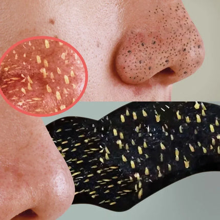 10-100pcs Charcoal Blackhead Remover Mask Blackhead Spots Acne Treatment Mask Nose Sticker Cleaner Nose Pore Deep Clean Strip