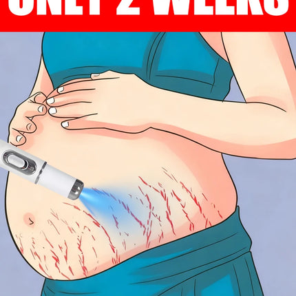 Striae Laser Device Eliminate Body Stretch Marks Products