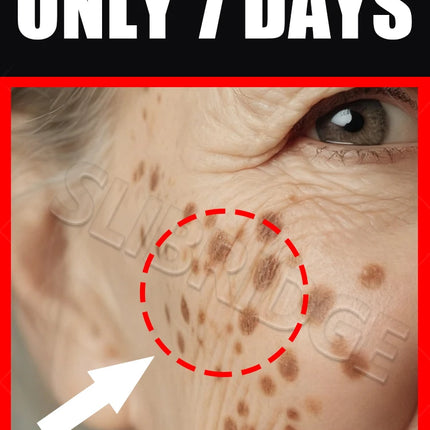 2025 Hot Sale Cleaning Melasma Tools Dark New Upgrade Spots care Tool