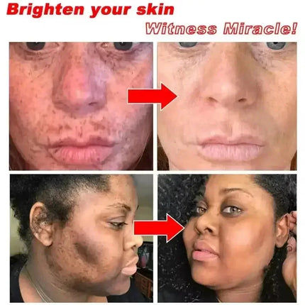 Niacinamide Whitening Spot Removal Cream Dark Spot Corrector Face Cream Melasma Freckle Sun Spot Remover Brighten Anti-Aging 30g
