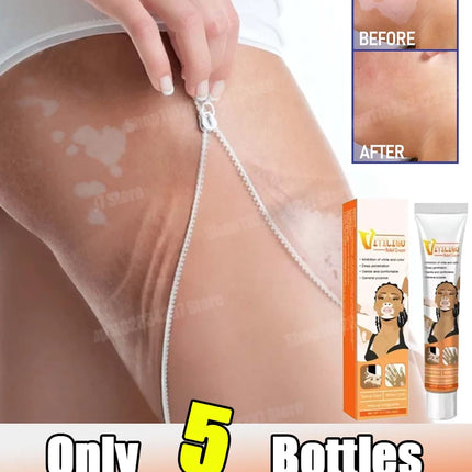[New] Vitiligo Cream Vitiligo Remover Tinea Versicolor Body Lotion Helps Get Rid of Sweat Spot Vitiligo, Skin Vitiligo Clear
