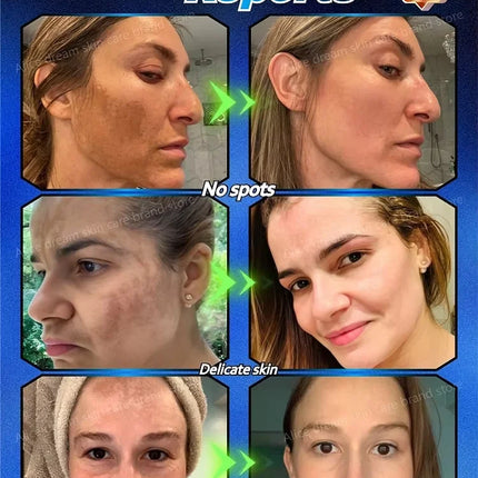 2025 Bestselling Facial Spot-Fading Cream, Effectively Removes Facial Dark Spots