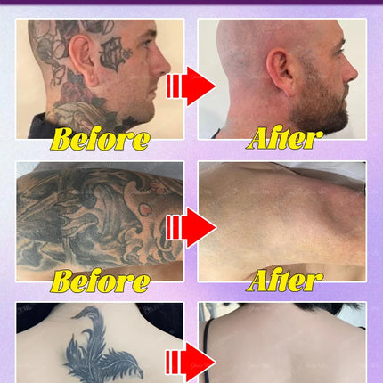 Fast and effective tattoo removal, no laser required, no pain, no marks left