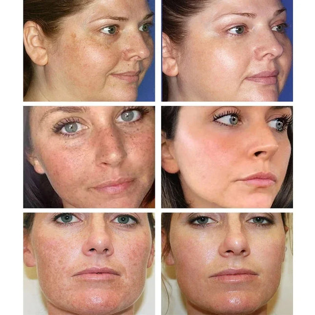 Effective Whitening Freckles Cream Remove Melasma Dark Spots Fade Melanin Pigmentation Moisturizing Brighten Skin Care Products