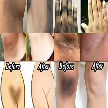 Nicotinamide Brightening Cream For Dark Skin Effective Lighten Thigh Inner Bleach Remove Melanin Private Parts Brighten Cream