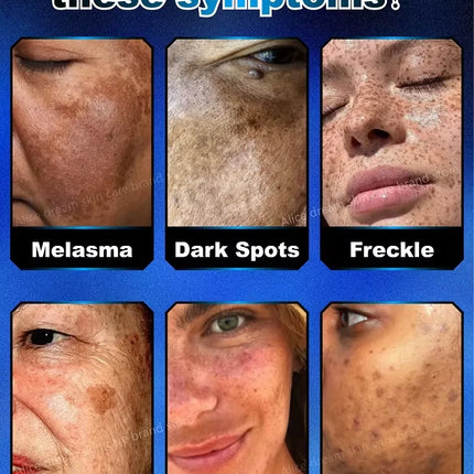 2025 Bestselling Facial Spot-Fading Cream, Effectively Removes Facial Dark Spots