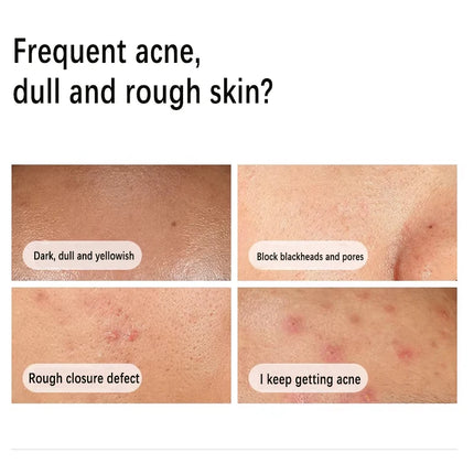 Niacinamide 10% + Zinc 1% Serum 30ml Control Oil Remove Acne and Brighten Oily Skin Gentle Exfoliating Closed-mouth Essence