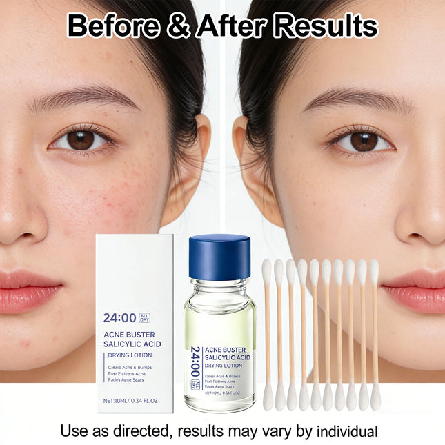Salicylic Acid Drying Lotion Face Serum with Cotton Swab – Reduce Pimples & Breakouts, Fade Acne Scars, Minimize Pores, Skin Renewal