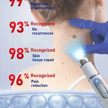 Blue Light Wart Remover Tool Painless Wart Removal Improve Skin Condition Better Life