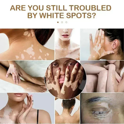 [New] Vitiligo Cream Vitiligo Remover Tinea Versicolor Body Lotion Helps Get Rid of Sweat Spot Vitiligo, Skin Vitiligo Clear