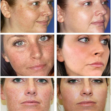 Powerful Spot-removing Whiten Cream Brighten Skin Fast Eliminates Melanin Pigmentation Melasma Dark Spots Moisturize Beauty Gel