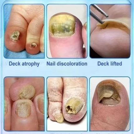 Quickly eliminate fungus and restore healthy nails  9