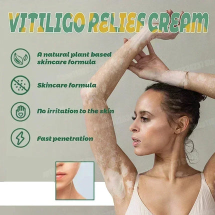 [New] Vitiligo Cream Vitiligo Remover Tinea Versicolor Body Lotion Helps Get Rid of Sweat Spot Vitiligo, Skin Vitiligo Clear