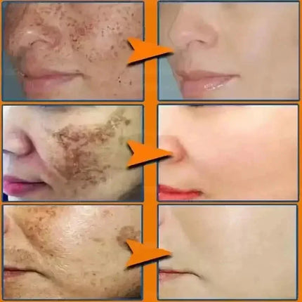 Niacinamide Whitening Spot Removal Cream Dark Spot Corrector Face Cream Melasma Freckle Sun Spot Remover Brighten Anti-Aging 30g