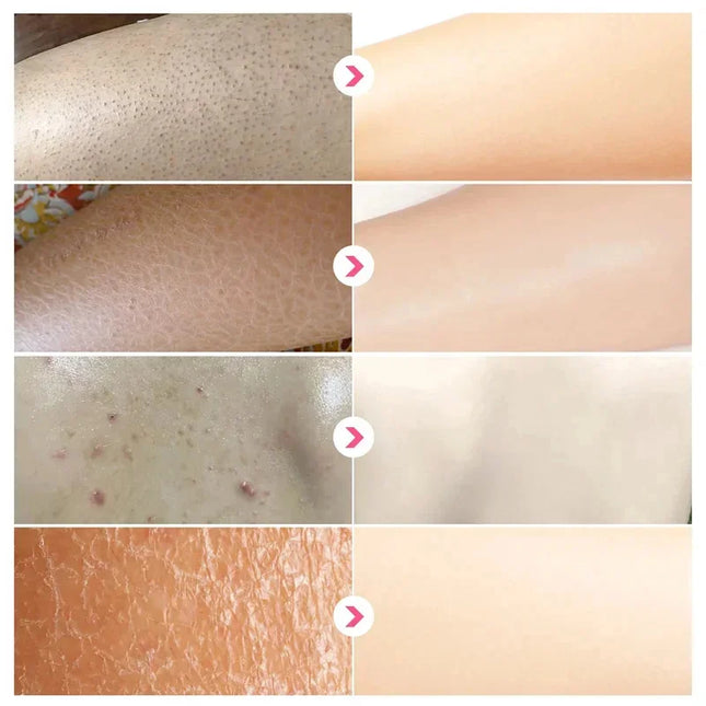 Body Whitening Cream Keratosis Pilaris Treatment Bumpy Rough Chicken Follicle Skin Repair Strawberry Legs Removal Dry Skin Care