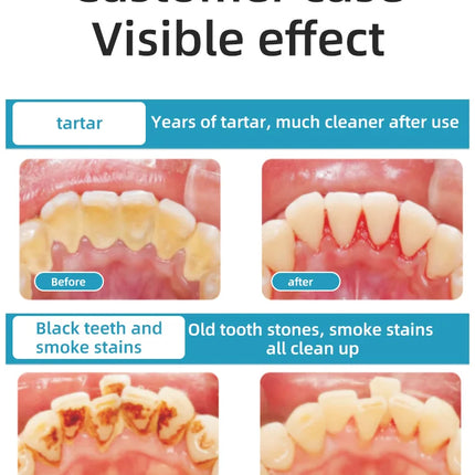 Ultrasonic teeth cleaner, home automatic teeth whitening device, removes tartar and plaque, teeth whitening cleaning tool