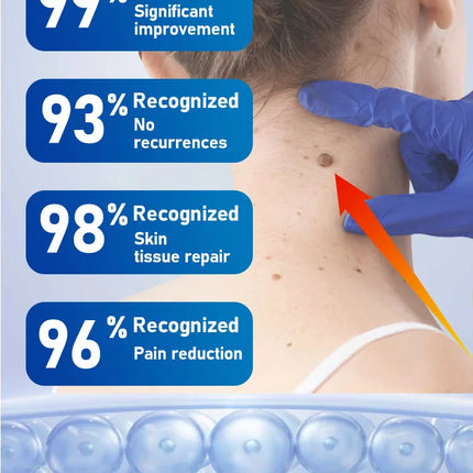 Safe and effective blue bottle, remove warts body tools wart freeze
