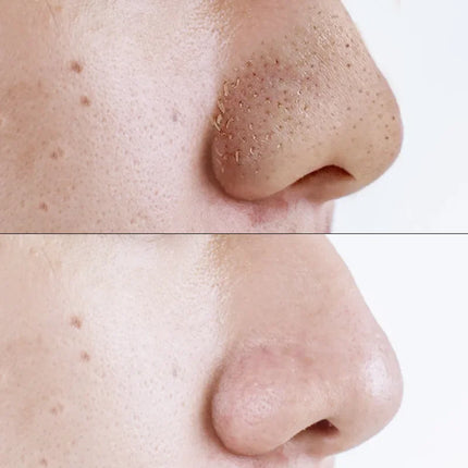 10-40pcs Blackhead Remover Nose Sticker Acne Treatment Mask Nose Sticker 5-60pc From Black Dots Cleaner Nose Pore Cleaning Skin