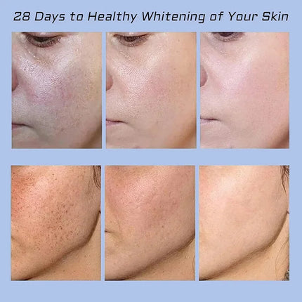 Niacinamide Whitening Spot Removal Cream Dark Spot Corrector Face Cream Melasma Freckle Sun Spot Remover Brighten Anti-Aging 30g