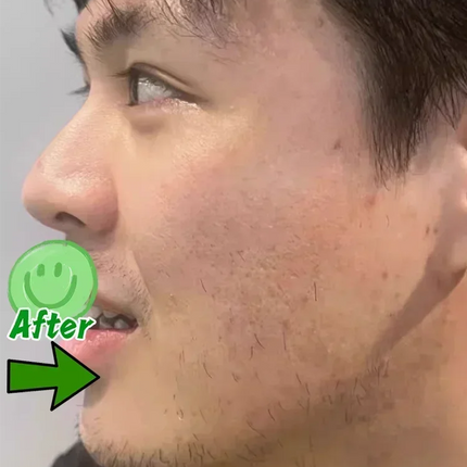 Anti-acne mark pothole Repair Men's Hole Repair Cream Fade to remove acne mark scar fade fill regeneration gel