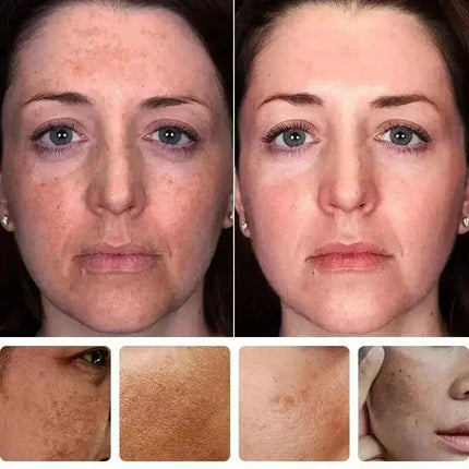 Niacinamide Whitening Spot Removal Cream Dark Spot Corrector Face Cream Melasma Freckle Sun Spot Remover Brighten Anti-Aging 30g