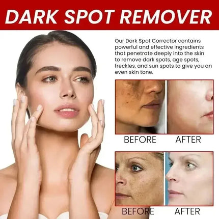 Niacinamide Whitening Spot Removal Cream Dark Spot Corrector Face Cream Melasma Freckle Sun Spot Remover Brighten Anti-Aging 30g