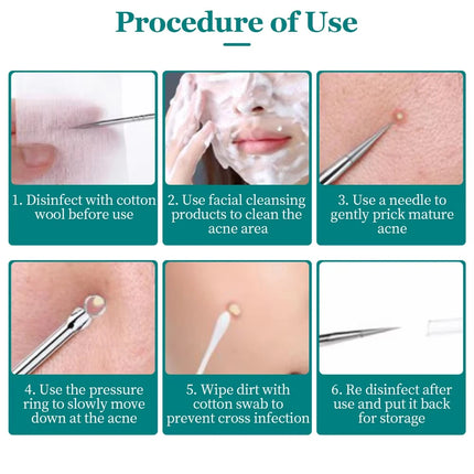 Ultra-fine No.5 cell blackhead and acne tweezers for facial beauty a special needle tool for women to remove blackheads and acne