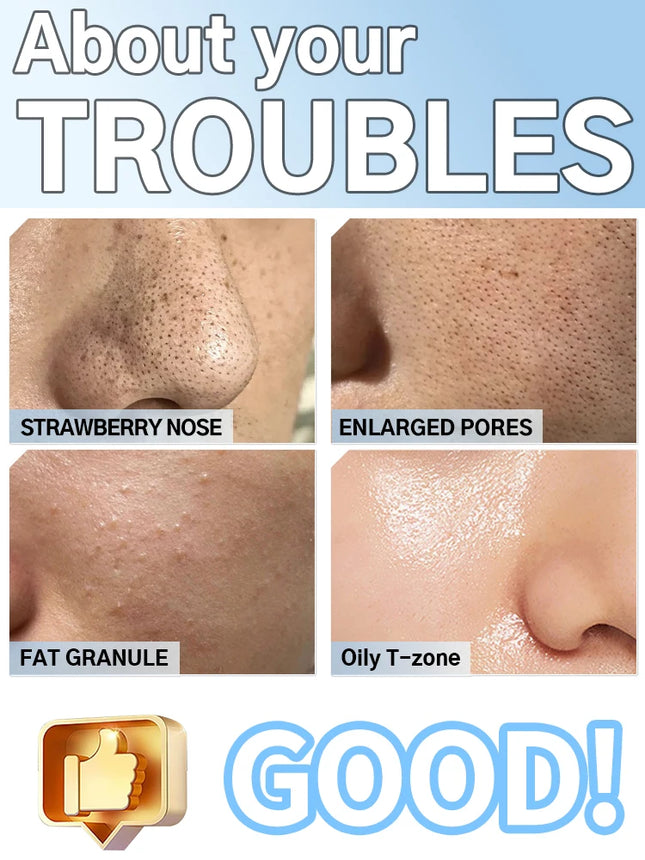 Facial Skin Care Pore Removal Cleanser Vacuum Black Spots Removal For Deep Facial Pores 5 Suction Power Blackhead Remover Pore